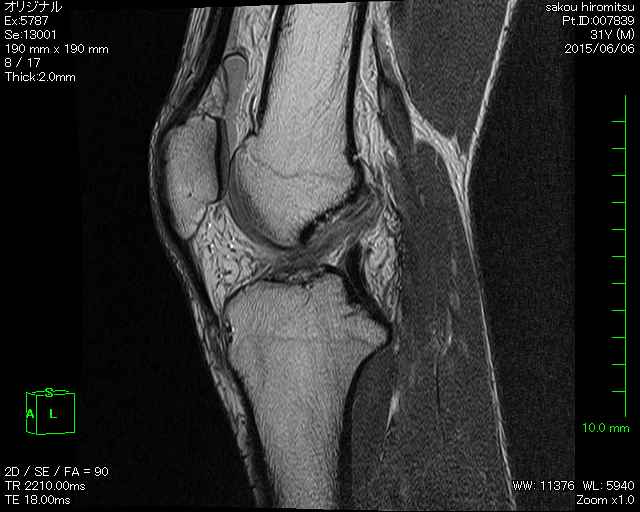 前十字靭帯,半月板,損傷,MRI