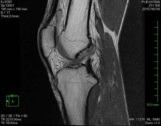 2015年に撮影した右膝のMRI画像。前十字靭帯の線がぼやけており、損傷が疑われた。