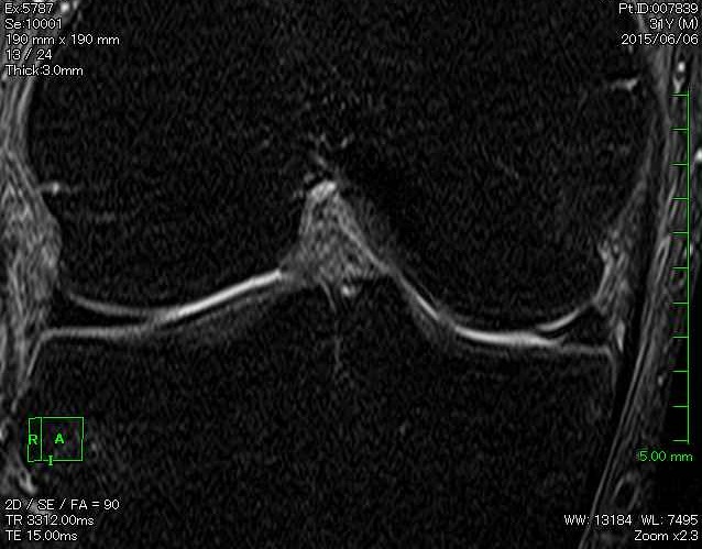 半月板損傷が疑われる膝のMRI画像（内側半月板の断裂と変形）