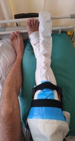 前十字靭帯・半月板手術後1日目の足の様子