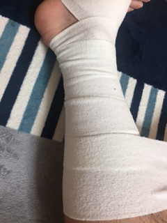 包帯を半分ずつ重ねながら巻いた例