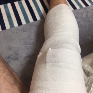 ふくらはぎから太ももまで包帯を巻いた状態