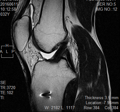 膝周辺を写したMRI画像。私が検査を受けた際に記録としてもらったスキャンデータの一部を掲載しています。