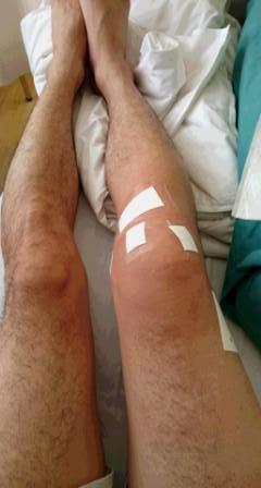 膝の手術から3日目の様子。腫れとテープ固定が残っている術後の状態」