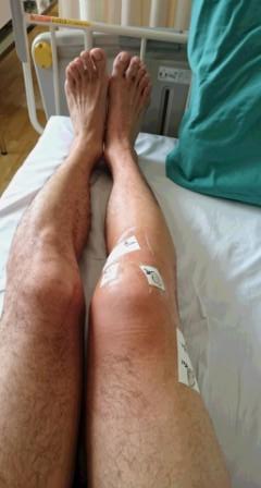 前十字靭帯と半月板の手術後5日目の右膝。腫れと熱感がまだ残っており、複数のガーゼとテープで保護されている様子