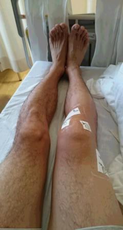 前十字靭帯と半月板手術から7日目の右膝の腫れとテープ処置の様子