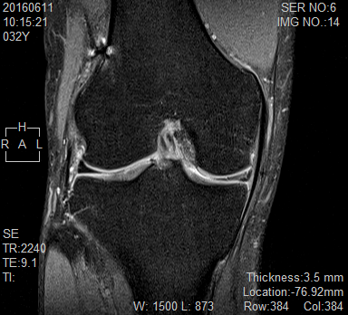 膝の内側付近を撮影したMRI画像。半月板周辺の状態を示す診断用データ