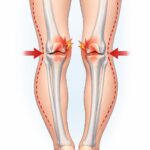 Ｏ脚は膝のケガの原因になる？受傷リスク・原因・改善方法をわかりやすく解説